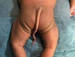 Fenomena Bayi Lahir Berekor Sepanjang 12 Cm 