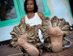 5 Penyakit Paling Aneh Pernah Menghebohkan Indonesia Pada Masanya